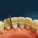 Шинирование подвижных ​зубов