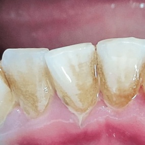 Удаление зубного камня