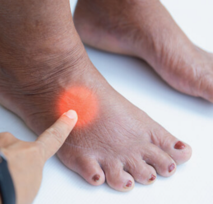 Особенности при сахарном диабете (диабетическая стопа)