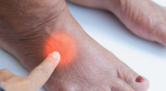 Особенности при сахарном диабете (диабетическая стопа)