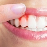 Лечение гингивита